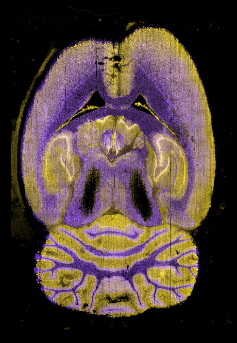Closeup shot of Two Brain Masses